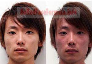 asian man before and after alcohol allergy