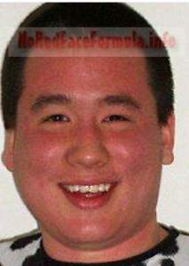asian man with alcohol allergy red face
